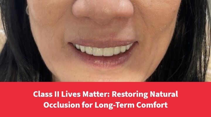 Class II Lives Matter: Restoring Natural Occlusion for Long-Term Comfort